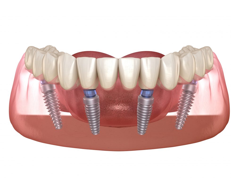 Implant Dentures – Everything You Need To Know