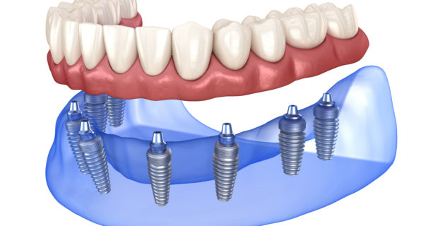 Implants Dentures